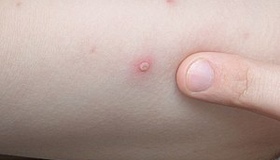 На Полтавщині зростає захворюваність на вітряну віспу